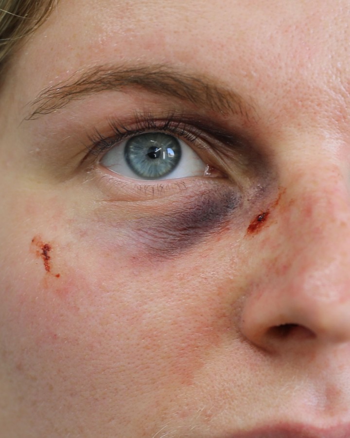 Black Eye A